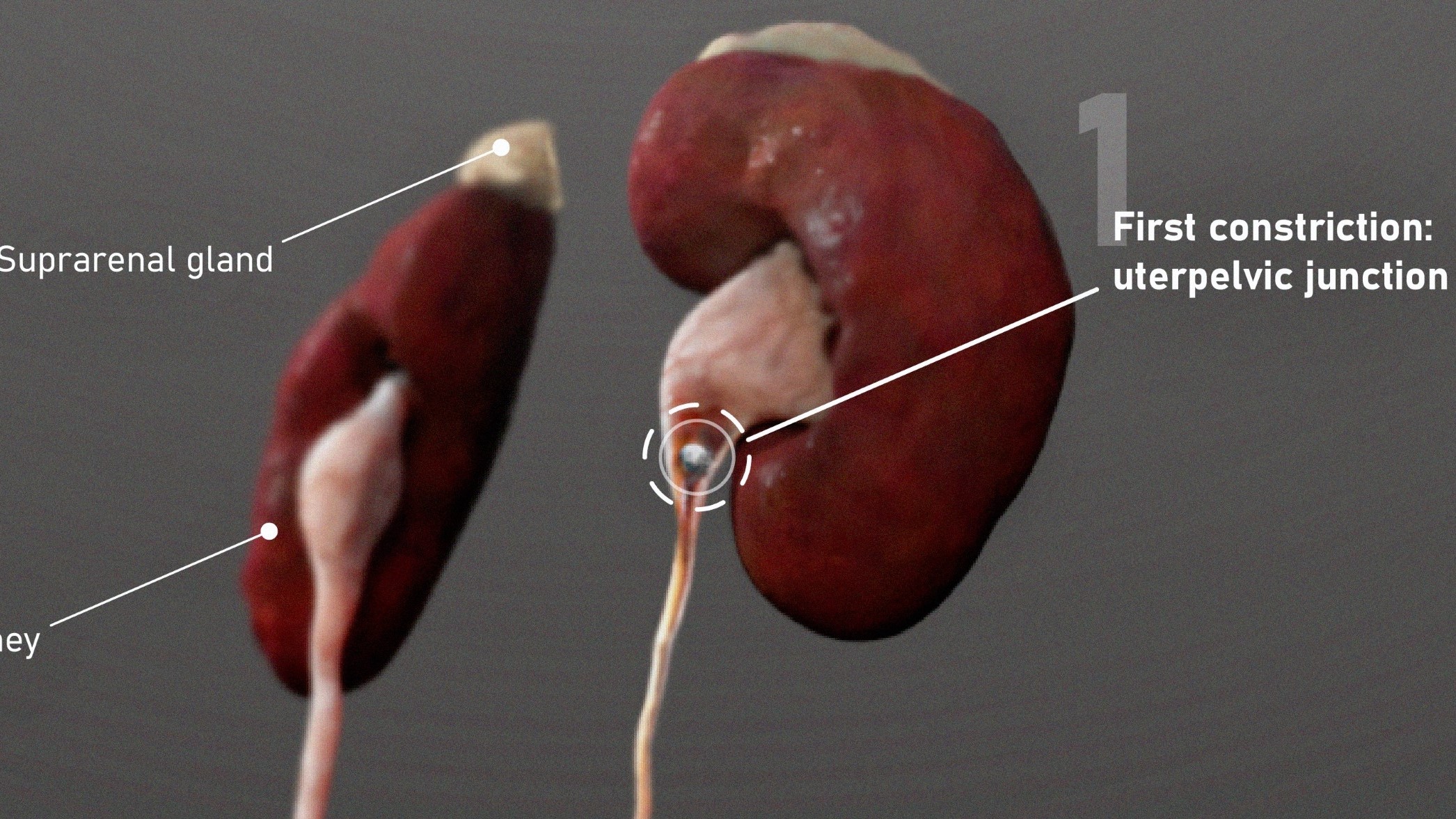 Common Kidney Stone Lodging Sites